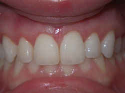 Cosmetic Periodontal Surgery